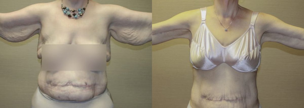 Breast Lift  The Plastic Surgery Clinic of Jackson