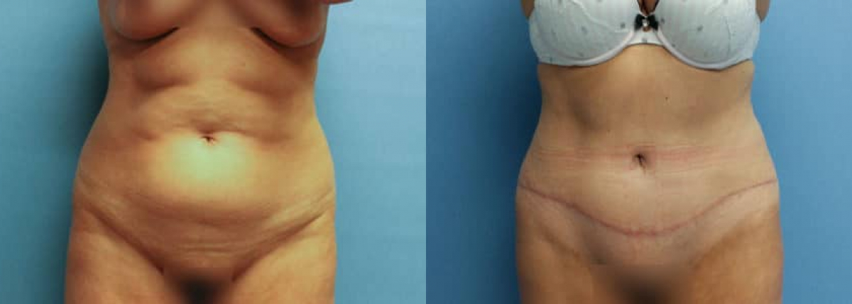 All About Tummy Tuck Scars  Spring Ridge Plastic Surgery